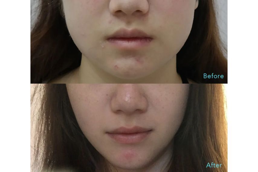 Non Surgical Face Slimming